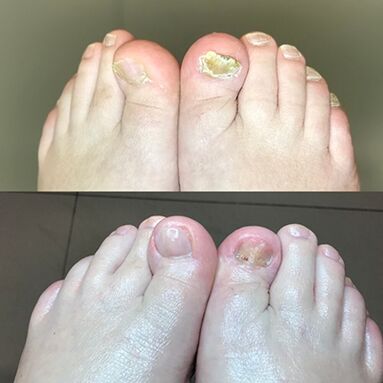 Zkušenosti s používáním krémového barnabase z Promicil z Izraele, fotografie před a po