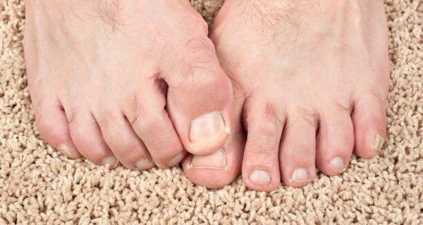 Příznaky nehtových houby