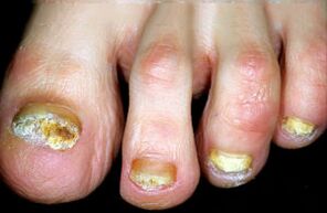 Charakterizace nemoci