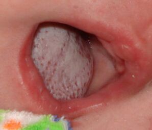 Lokalizace nemoci s houbou