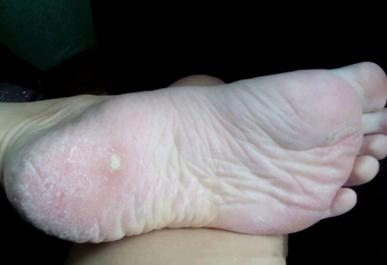 Léčba houby laserem