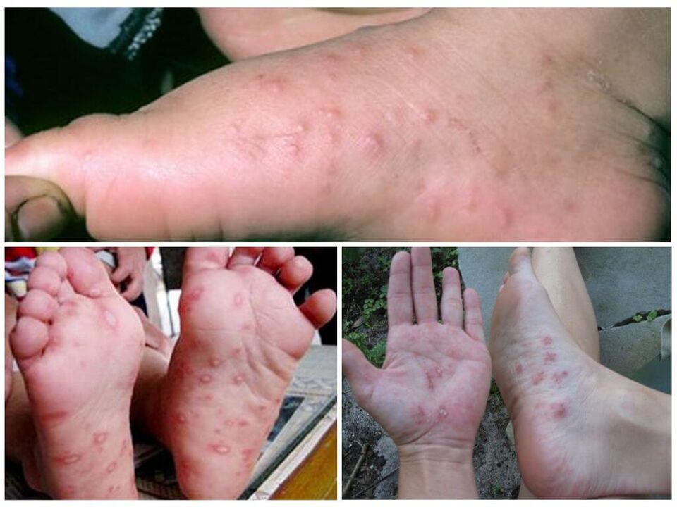 Hyperkeratotické léze nohou