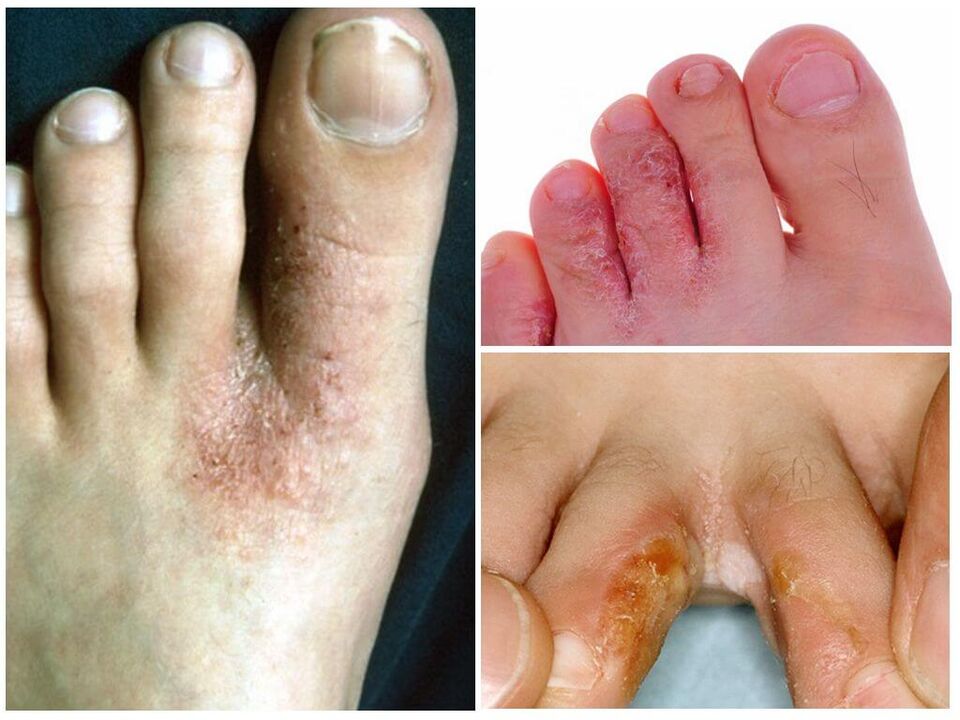 Interdigitální mykóza