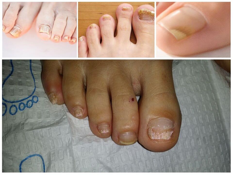 Plísňová onemocnění nehtových plotének