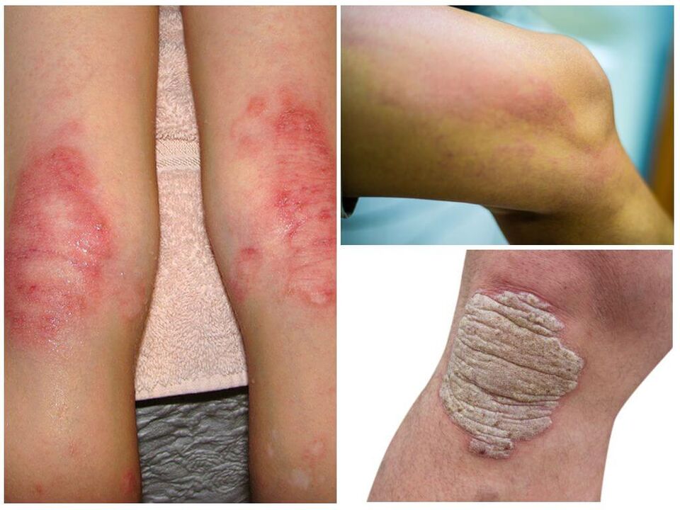 Plísňové infekce kolen