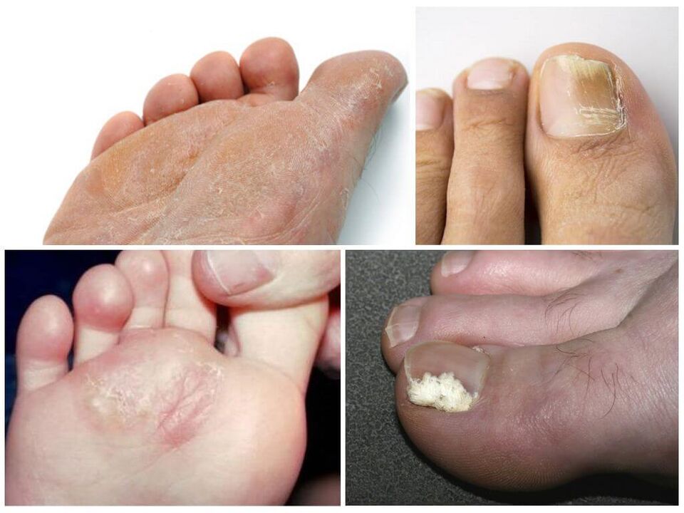 Počáteční fáze plísně nohou