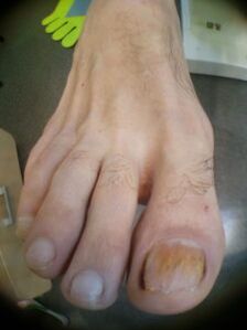 plíseň nehtů na palcích u nohou