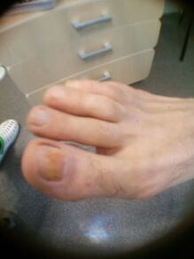 počáteční fáze plísně nehtů na palci u nohou