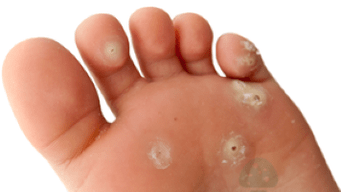 druhá fáze plísňové infekce