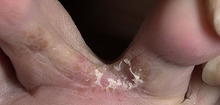 houba mezi prsty na nohou